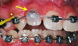 Cire sur broche irritation © orthodontiste Lemay sherbrooke Les parties les plus irritantes des appareils peuvent être recouvertes de cire pour soulager temporairement.