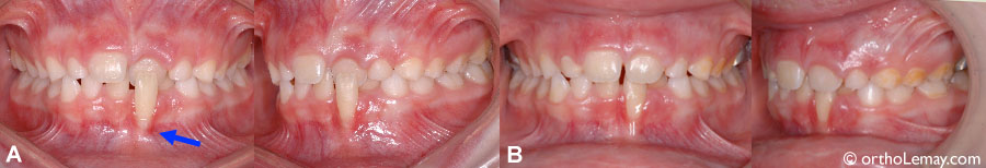 Crossbite anterieur Orthodontiste Lemay 535783 (A) Occlusion croisée entre une centrale supérieure (basculée vers l'intérieur) et une incisive inférieure (basculée vers l'avant). Une récession (perte de gencive) est évidente sur la dent inférieure. (B) Correction après 7 jours; la gencive inférieure est toujours basse mais peut "récupérer" un peu avec le temps. Sans correction les dents peuvent s'user et la perte de gencive peut progresser.