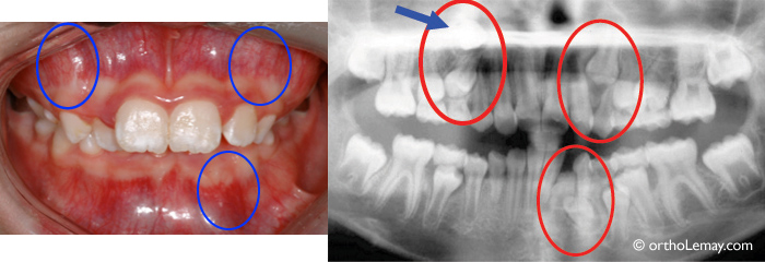 Eruption-problème malocclsusoin dentaire orthodontie 531347 EC9 Problèmes d'éruption visibles sur une radiographie.