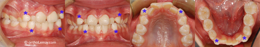 Extractions sélectives série orthodontie Serbrooke 535495 OM9