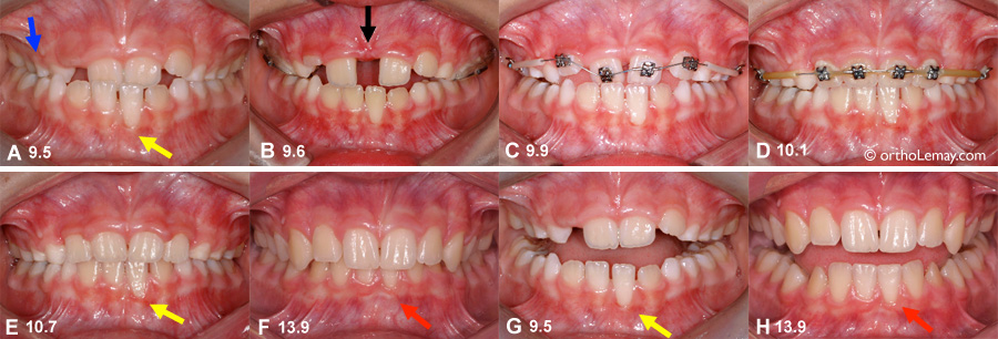 Interception orthodontique expansion malocclusion dentaire otholemay 073004 MG9 comp Exemple d'une intervention précoce en orthodontie