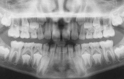 Normal eruption radiographie panoramique 533044