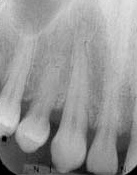 Periapicale radiograph VSt-amant ortholemay Radiographie dentaire péri-apicale
