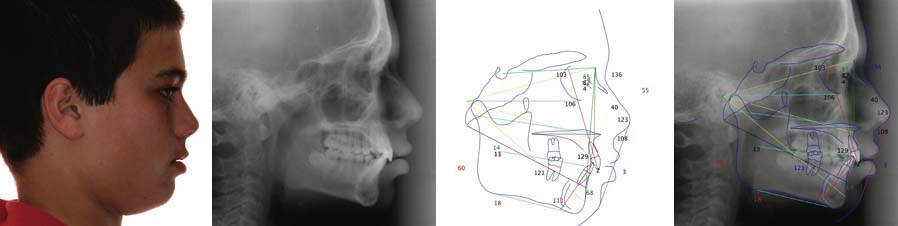 Simulation de traitement orthodontique orthoLemay.com orthoLemay.com