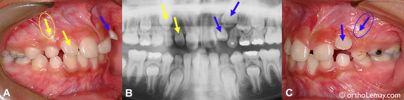 Problème éruption dentaire radiographie orthodontie 536070JC