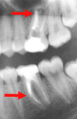 Traitement de canal root canal treatment orthodontistes Lemay 083217