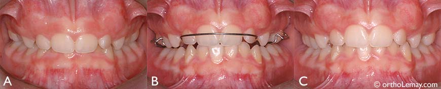 Bite plane Orthodontiste Lemay KB 093259 v2 L'utilisation d'un "bite plane" (plan articulé) agissant aussi comme mainteneur d'espace a permis de dégager les dents inférieures en diminuant le surplomb vertical.