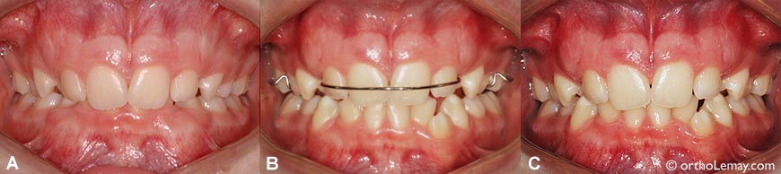 Bite plane orthodontics Lemay CM 533747 ex 2