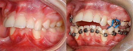 Bite plane orthodontiste sherbrooke KG 093270 Plan guidé utilisé en début de traitement avec des élastiques