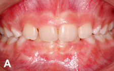 Deep-bite-malocclusion-dentaire-535998SMC-orthodontiste-sherbrooke v2 Malocclusion et migraines, maux de tête
