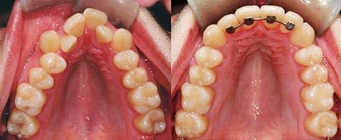 Expansion sans chirurgie orthodontiste Lemay 063036 b Expansion (élargissement) de la mâchoire supérieure obtenue sans appareil d'expansion ou chirurgie chez un jeune adulte de 25 ans.