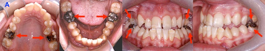 Pré-traitement : Extractions de 4 molaires abimées (flèches) afin d'éviter plusieurs travaux dentaires à la patiente.