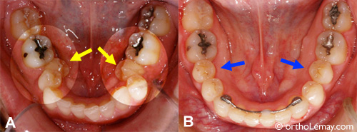 Perte espace mainteneur orthodontie sherbrooke malocclusion 063191 IG Un mainteneur d'espace aurait pu éviter ce problème d'éruption et le besoin de correction orthodontique.