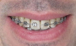 Sourire avec appareil dentaire orthodontique 