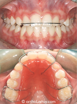 Upper-space-maintainer-orthodontiste sherbrooke2 Mainteneur d'espace supérieur amovible appareil dentaire orthodontique
