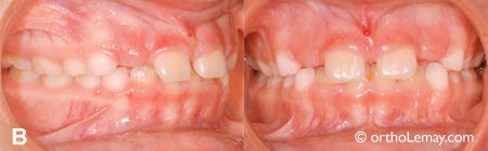 deep bite maux de tete bite plane orthodontie 536100 JJ9 malocclusion et maux de tête chez un enfant