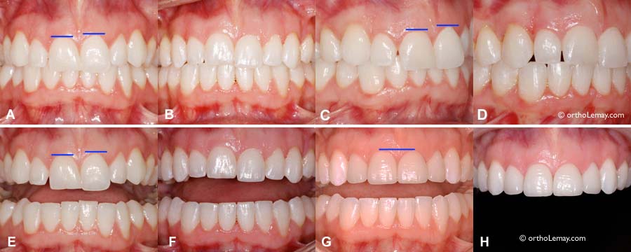 L'orthodontie permet de modifier la position des dents et le sourire.