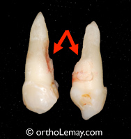 Résorption racine dentaire orthodontie canine incluse malocclusion dentaire 103112SBJ21 Résorption de racine par une canine incluse. Extraction avant un traitement d'orthodontie.