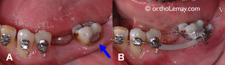 amalgame dentaire bague orthodontique attache molaire orthodontie sherbroke 103290 JJ40 bague orthodontique posée sur un amalgame dentaire
