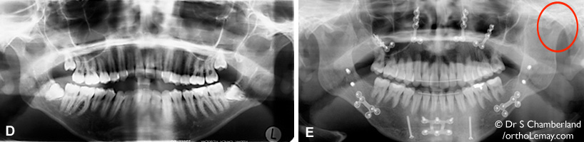 Radiographie montrant la résorption des condyles suite à une chirurgie