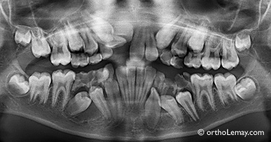 Problème d'éruption ectopique et malocclusion en orthodontie