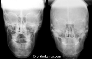 Cephalometrie antero posterieure orthodontie Lemay