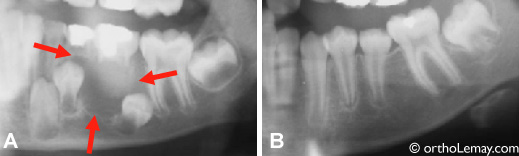 pathologie radiographie dentaire orthodontics orthodontiste sherbrooke 534584JTM