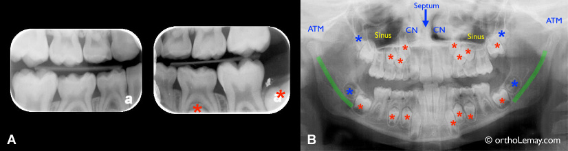 radiographie dentaire radiograph comparison 537080 DL8 orthodontie Comparaison entre différents types de radiographies dentaires utilisées en orthodontie.