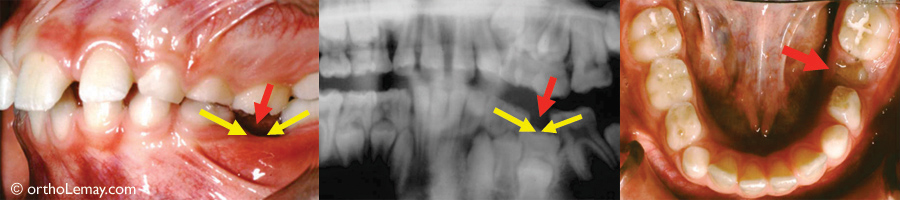 Ankylose dentaire perte espace malocclusion ankylosis orthodontie sherbrooke