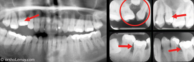 Ankylose dentaire radiographie malocclusion orthodontiste sherbrooke