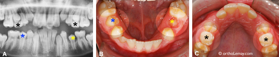 Leeway space espace éruption dentaire orthodontie 093268 SBT117 Espace leeway disponible pour l'éruption des dents