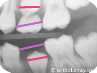 Leeway space radiograph orthodontiste sherbrooke v2 Radiographie espace leeway, espace de dérive