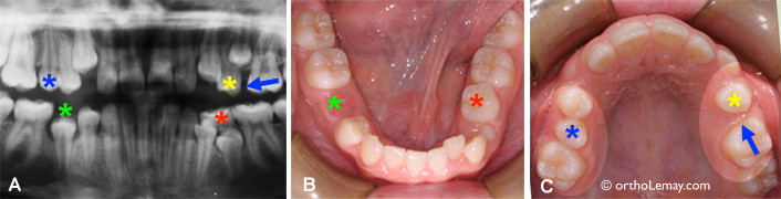 espace leeway malocclusion dentaire orthodontiste sherbrooke 531660 RML13 espace disponible pour l'éruption des dents