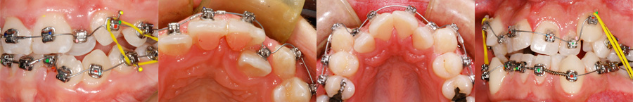 Fil flexible en CuNiTi utilisé en orthodontie
