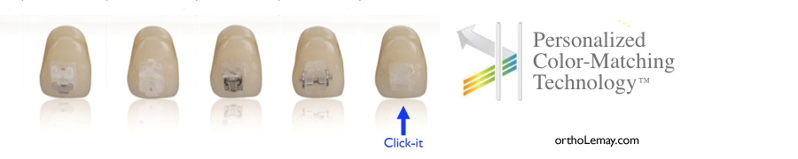Click-it comparison bracket boîtiers orthodontiques Click-it orthodontic bracket tp orthodontics. Boîtiers orthodontiques invisibles