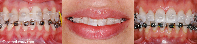 Click-it orthodontic bracket boîtier 113236 LL48 113246 RR25 Click-it orthodontic bracket, boîtier orthodontic de TP Orthodontics