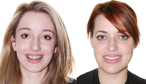 Click-it orthodontic bracket orthodontie sherbrooke 123032 113246 Boîtiers Click-it posés sur l'arcade supérieure