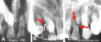 Tractin de canine incluse à l'aide d'un lasso, résorption radiculaire. 