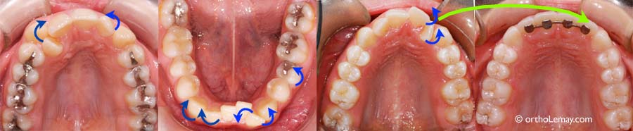 Correction de rotations et malpositions dentaires en orthodontie