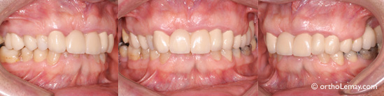 apnee ronflement malocclusion orthodontie sherbrookeBG58 Traitement de l'apnée du sommeil et du ronflement