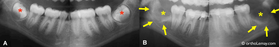 extraction  d'une dent de sagesse visible sur une radiographie panoramique