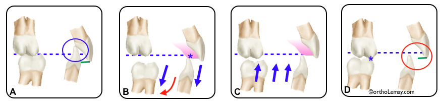 Plan articulé utilisé en orthodontie pour ouvrir l'occlusion