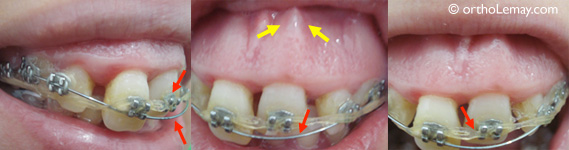 Déplacement dentaire urgence orthodontique