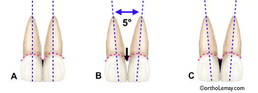Mauvaise inclinaison des dents et apparition d'un espace triangulaire noir inesthétique