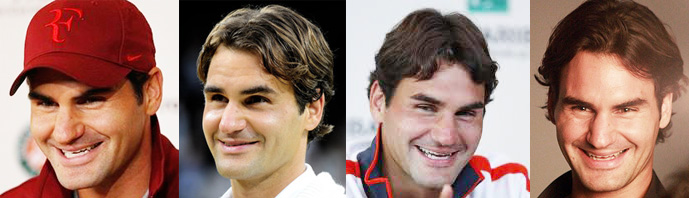 DÉficience maxillaire roger federer