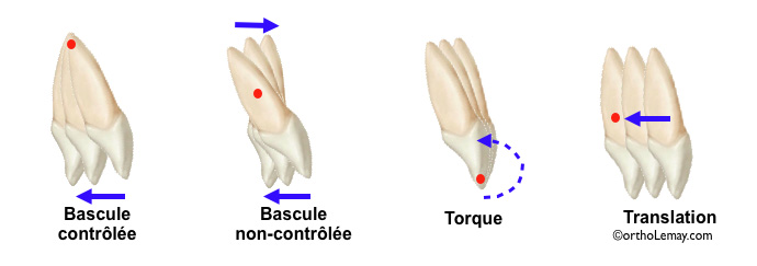 Mouvements dentaires orthodontiques; torque, tipping, bascule, translation