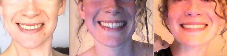 orthodontie exansion dentaire et sourire
