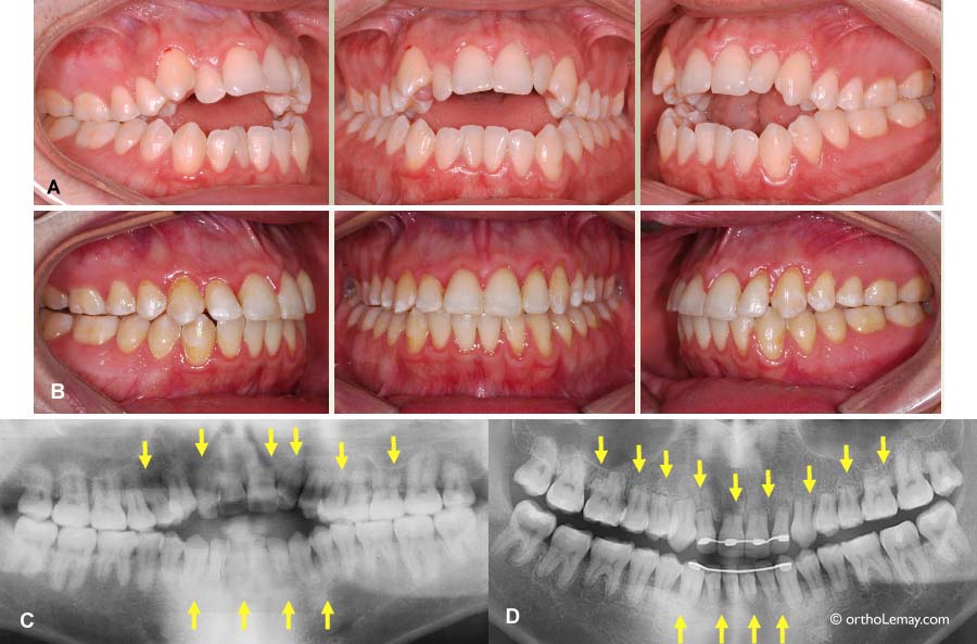 Résorption radiculaire (rhisalyze) et béance antérieure sévère traitée en orthodontie 