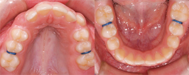 Utilisatin de séparateurs pour débloquer orthodontiques des dents
