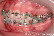Mouvement excessif des dents  et surcorrection avec des élastiques orthodontiques 
